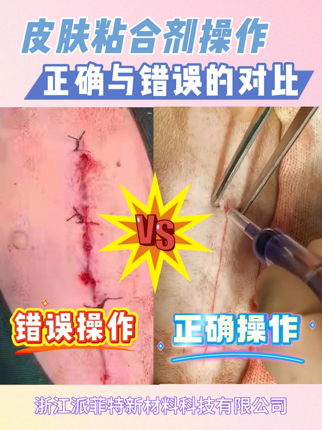 【避开误区 安全修复】医用皮肤粘合剂操作指南：错误VS正确手法全解析