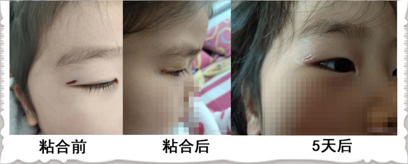 Wound-skin-glue-for-the-little-girls-upper-eyelid-wound-before-and-after.jpg