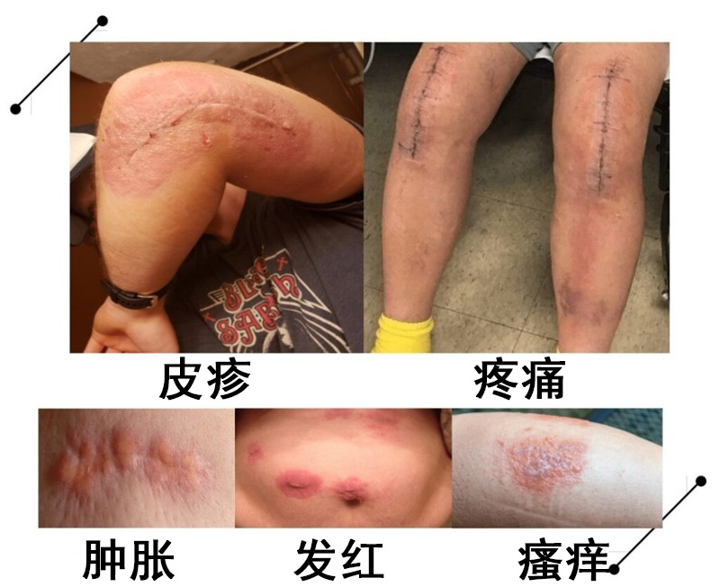 手术“胶水”是什么？术后愈合的新选择你了解吗？