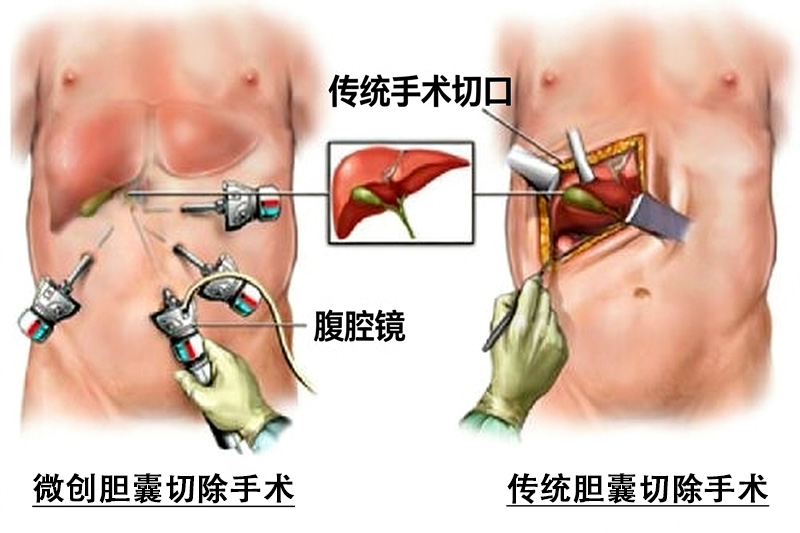 医用胶在胆囊切除术中的临床应用