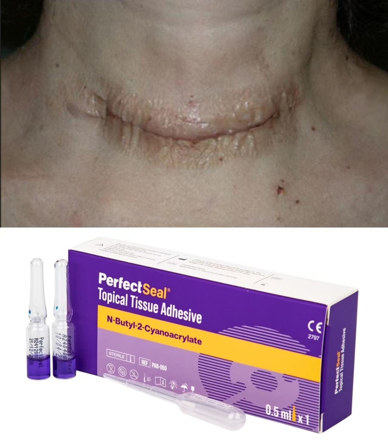 医用胶在普外科手术伤口护理中的应用与优势